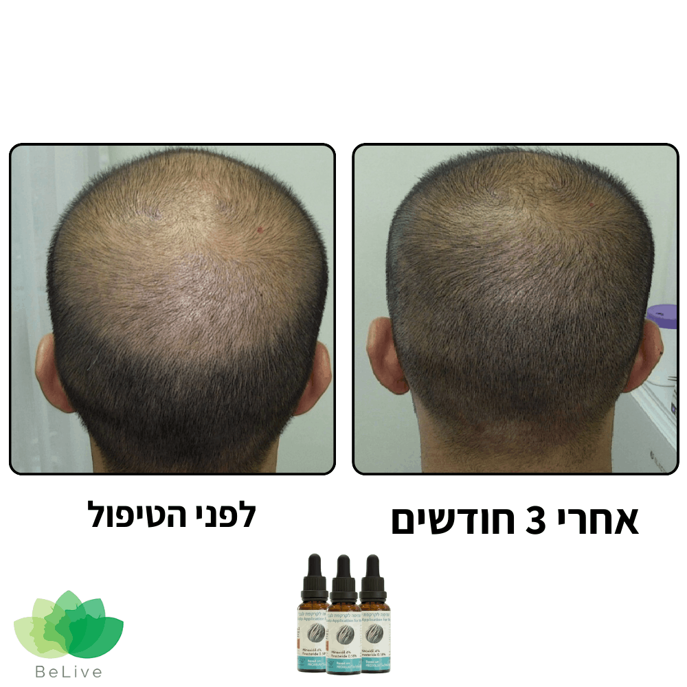 פורמולה רפואית PROXIUM לשיקום ועיבוי השיער לגבר