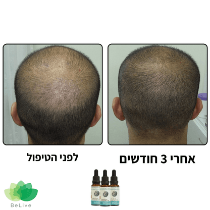 פורמולה רפואית PROXIUM לשיקום ועיבוי השיער לגבר