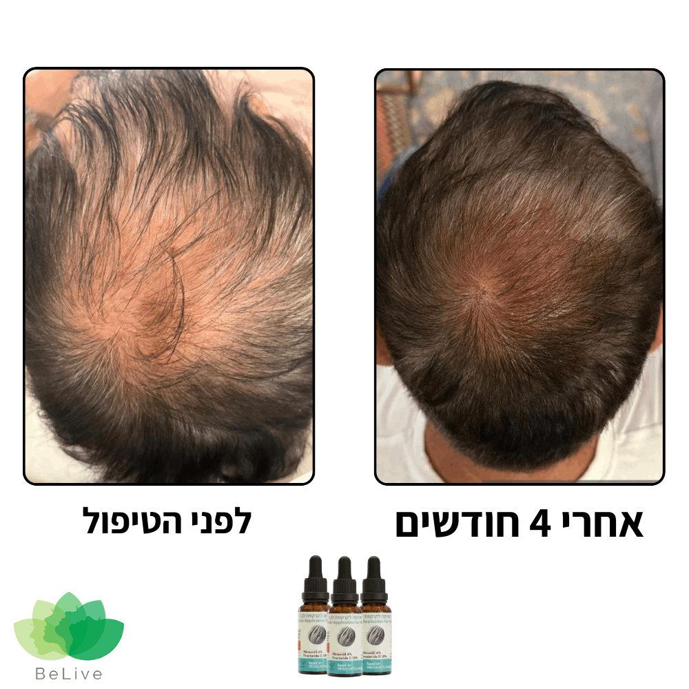 פורמולה רפואית PROXIUM לשיקום ועיבוי השיער לגבר