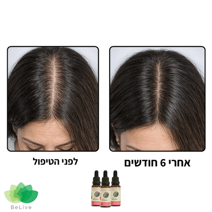 פורמולה רפואית PROXIL לשיקום ועיבוי השיער לאישה