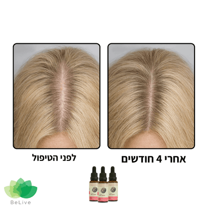 פורמולה רפואית PROXIL לשיקום ועיבוי השיער לאישה